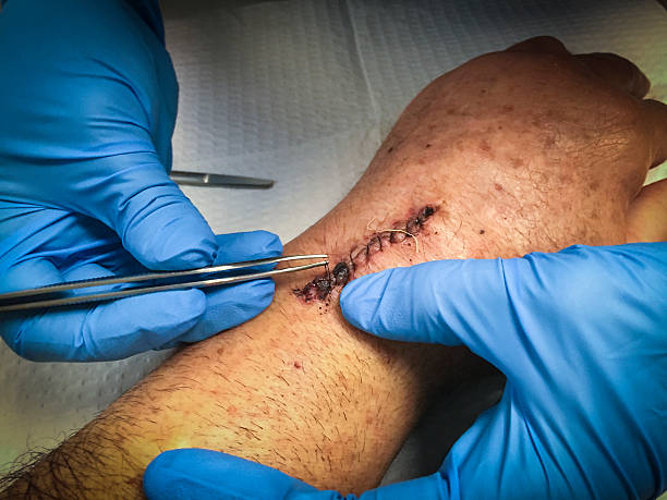 Suture /Stapler Removal (+/-)Dressing