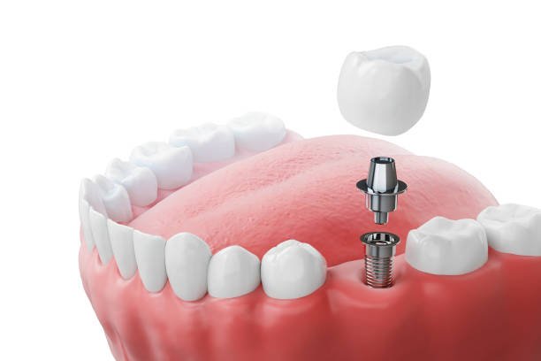 NOBLE BIOCARE (Without Crown)