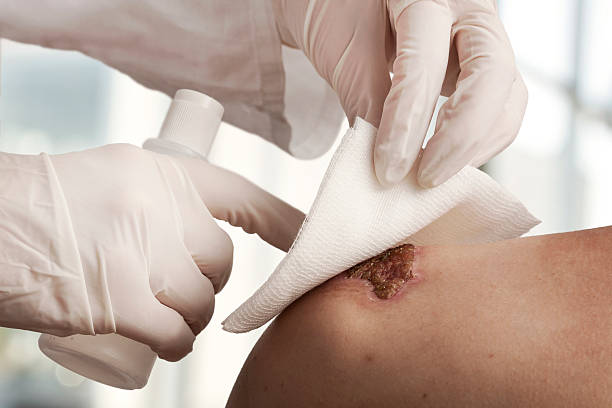 Wound Dressing