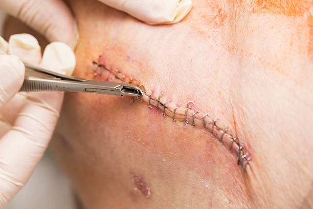 Stitches removal